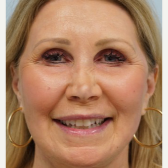 55-64 year old woman treated with Brow Lift after 3727770