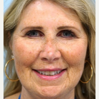 55-64 year old woman treated with Brow Lift before 3727770
