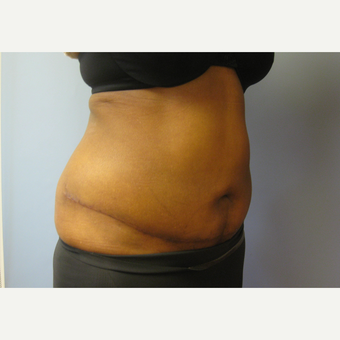 50 year old woman treated with mini tummy tuck and liposuction after 3108109