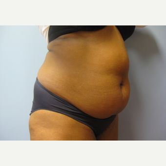 50 year old woman treated with mini tummy tuck and liposuction before 3108109