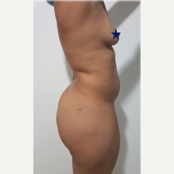 25-34 year old woman treated with tummy tuck before 3249606