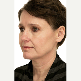 51 year old woman treated with Neck Lift before 3548798