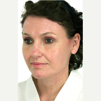 51 year old woman treated with Neck Lift after 3548798