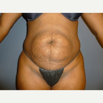 39 year old woman treated with Tummy Tuck, maintains her results one year post op before 1635887