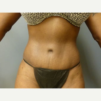 39 year old woman treated with Tummy Tuck, maintains her results one year post op after 1635887