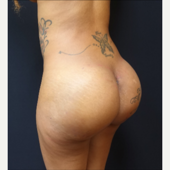 25-34 year old woman treated with 712cc Silicone Round Butt Implants after 3129121
