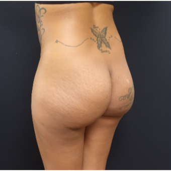 25-34 year old woman treated with 712cc Silicone Round Butt Implants before 3129121