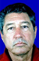 Facelift, necklift, superficial cheeklift, upper blepharoplasty before 83379