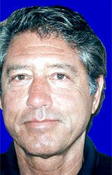 Facelift, necklift, superficial cheeklift, upper blepharoplasty after 83379
