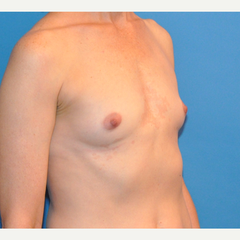 Breast Augmentation before 3783442