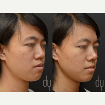Asian Rhinoplasty with Rib cartilage before 3622595