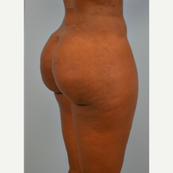 35 year old woman treated with Brazilian Butt Lift after 3432350