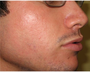 Intense Pulsed Light for Acne after 106462