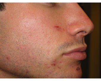 Intense Pulsed Light for Acne before 106462