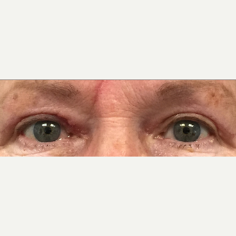 75 and up year old woman treated with Eyelid Surgery after 3841219