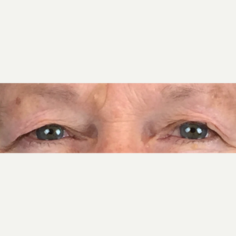 75 and up year old woman treated with Eyelid Surgery before 3841219