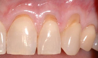 Gum Graft before 515414