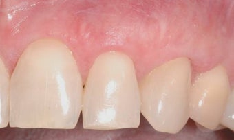 Gum Graft after 515414