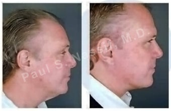 Lower Face and Neck Lift. before 138178