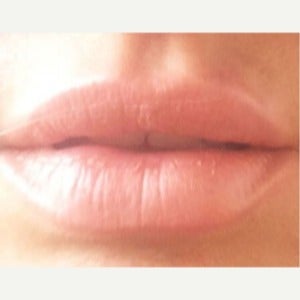 25-34 year old woman treated with Restylane after 1793760