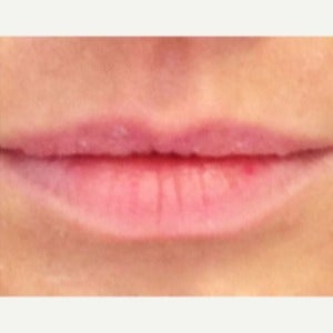 25-34 year old woman treated with Restylane before 1793760