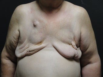 Breast reconstruction - tissue expanders before 877967