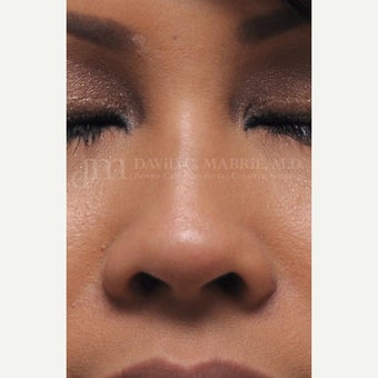 Woman treated with Non Surgical Nose Job 1843210