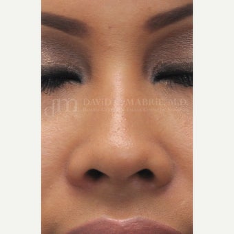 Woman treated with Non Surgical Nose Job 1843210