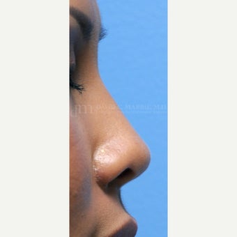 Woman treated with Non Surgical Nose Job after 1843210