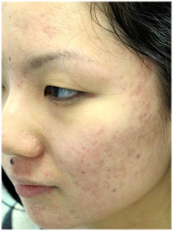 Acne Therapy after 667035