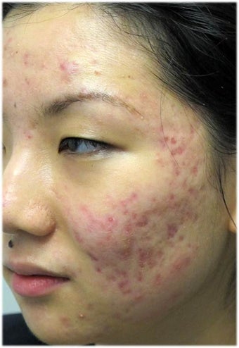Acne Therapy before 667035