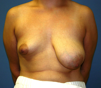 Breast Augmentation before 202666