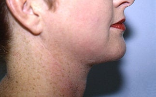 Neck Liposuction after 68404
