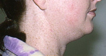 Neck Liposuction before 68404