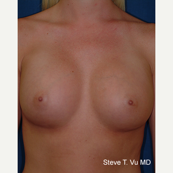 25-34 year old woman treated with Breast Augmentation after 3577120