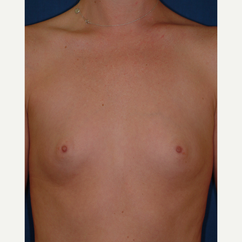 25-34 year old woman treated with Breast Augmentation before 3577120