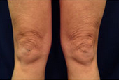 Body Laser Skin Tightening - Legs before 53750
