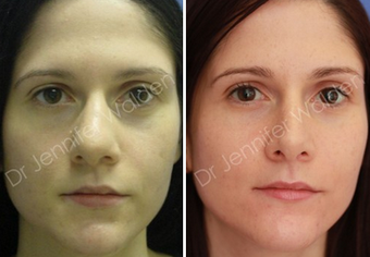 Septorhinoplasty before 1112644