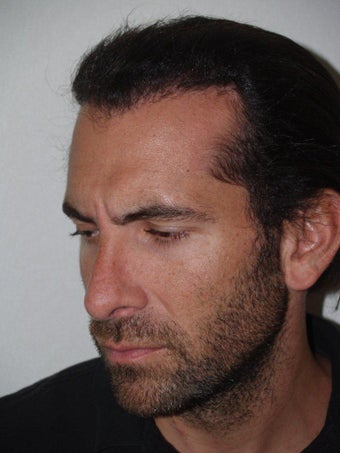 Hair Transplant and Rhinoplasty after 218116