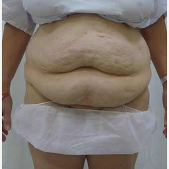 45-54 year old woman treated with Body Lift before 3419915