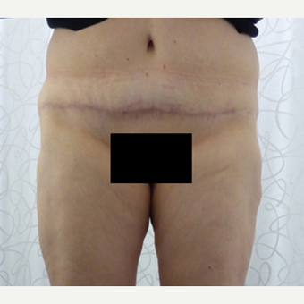 45-54 year old woman treated with Body Lift after 3419915