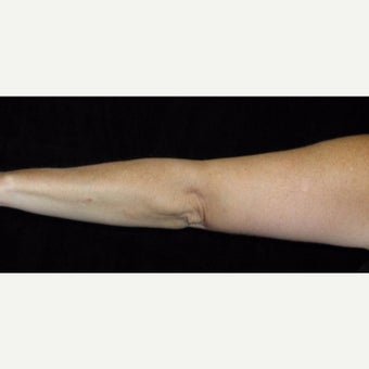 47 year old woman treated with Arm Lift after 2464033
