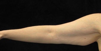 47 year old woman treated with Arm Lift 2464033