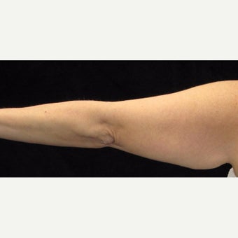 47 year old woman treated with Arm Lift before 2464033