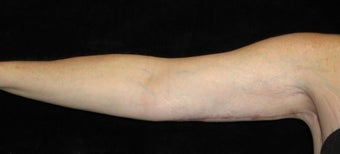 47 year old woman treated with Arm Lift 2464033