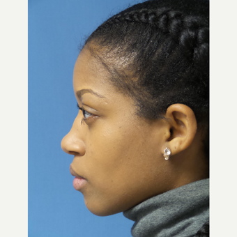25-34 year old woman treated with African American Rhinoplasty before 3098245