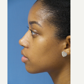 25-34 year old woman treated with African American Rhinoplasty after 3098245