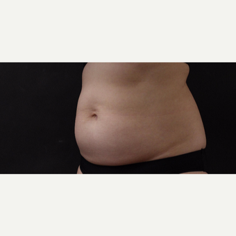 55 year old woman treated with CoolSculpting before 3220705