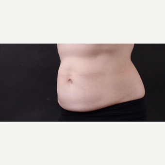 55 year old woman treated with CoolSculpting after 3220705