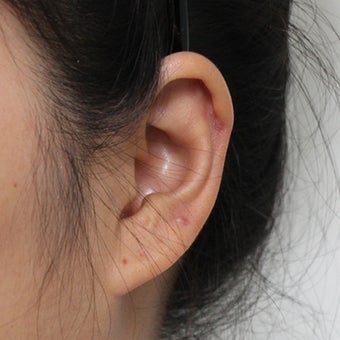 Ear Keloid Removal and Steroid Injection 3485528